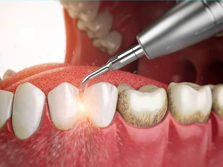 Teeth Cleaning and Polishing